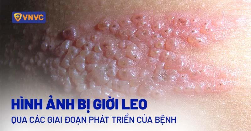Hinh anh minh hoa cac giai doan phat trien cua benh zona than kinh tren da